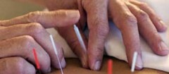 acupuntura-santa-rita-1402455754